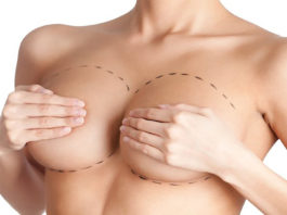 Cirugía de aumento mamario por el Dr. Antonio García