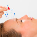 Cosmetic-Acupuncture