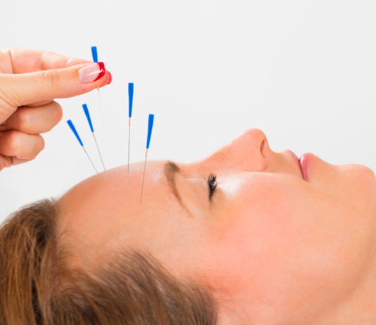 Frente al dolor, mejorar tus cefaleas con acupuntura, ¡es posible!